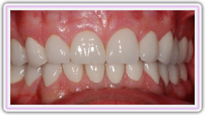 Full Mouth Reconstruction With All Porcelain Zirconia Crowns Cad Cam Milled