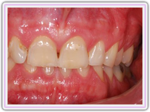 Loss Of Vertical Dimension Due To Wear Of Teeth