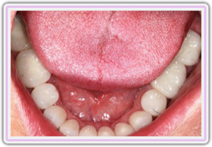 Lower Crowns After Delivery