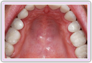 Upper Crowns After Delivery