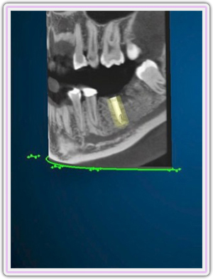 3d Positioning Of The Implant On The Lower Jaw