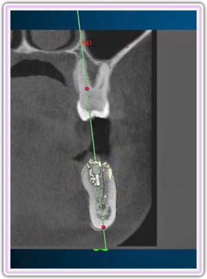 Computer Guided Implant Planning