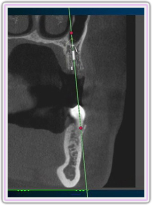 Ct Planning For Upper Jaw Implant