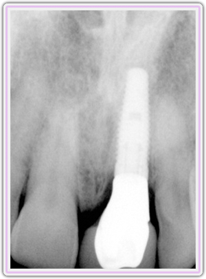 Final Xray Showing Implant