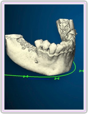 Guided Surgery Planning