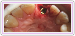 Immediate Implant Placement