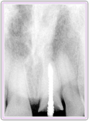 Preop Xray Showing The Fracture