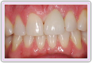 Procera Full Porcelain Crown In The Implant