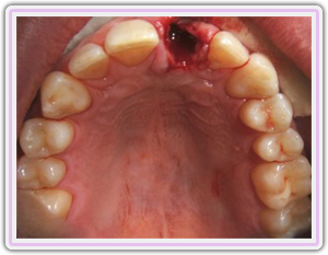 Removal Of Tooth