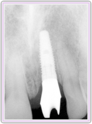 Xray Showing The Custom Abutment In Place